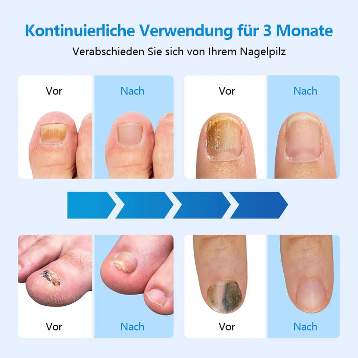 Nagelpilz-Licht für mehrere Zehennägel