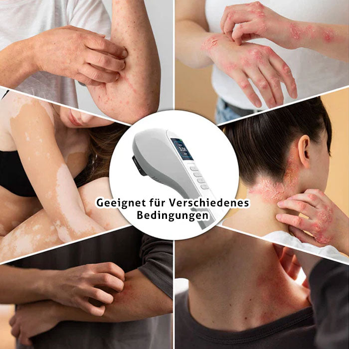 KTS Handheld-UVB-Lichttherapiegerät für Vitiligo/Psoriasis