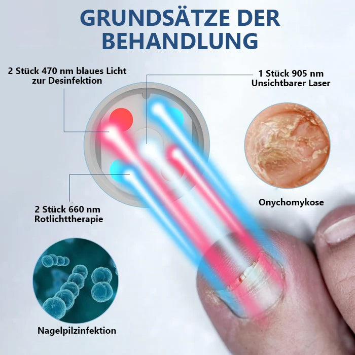 Schnelle Ergebnisse! KTS Laser-Lösung für gesunde Nägel