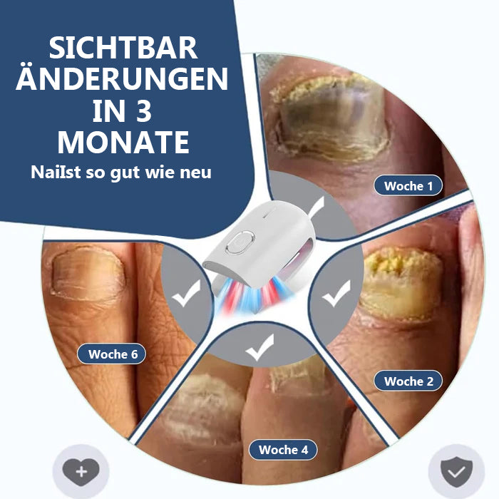 Schnelle Ergebnisse! KTS Laser-Lösung für gesunde Nägel