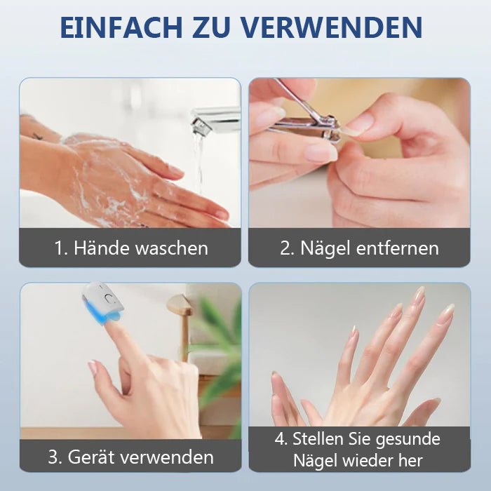 Schnelle Ergebnisse! KTS Laser-Lösung für gesunde Nägel