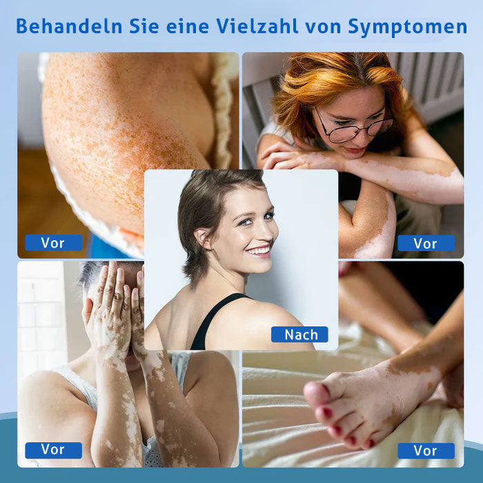 KTS Handheld-UVB-Lichttherapiegerät für Vitiligo/Psoriasis