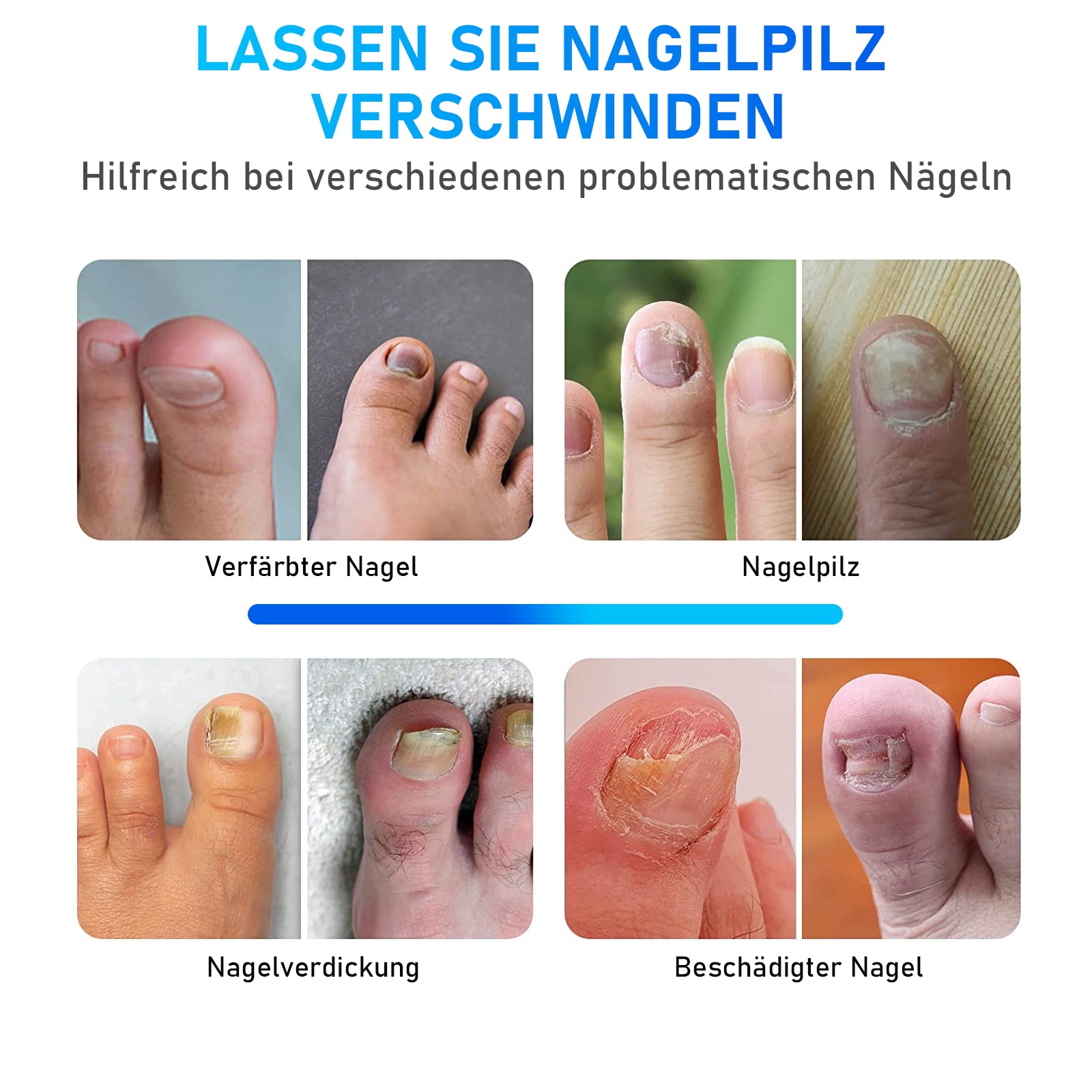 KTS® Nagelpilz Behandlungs Gerät