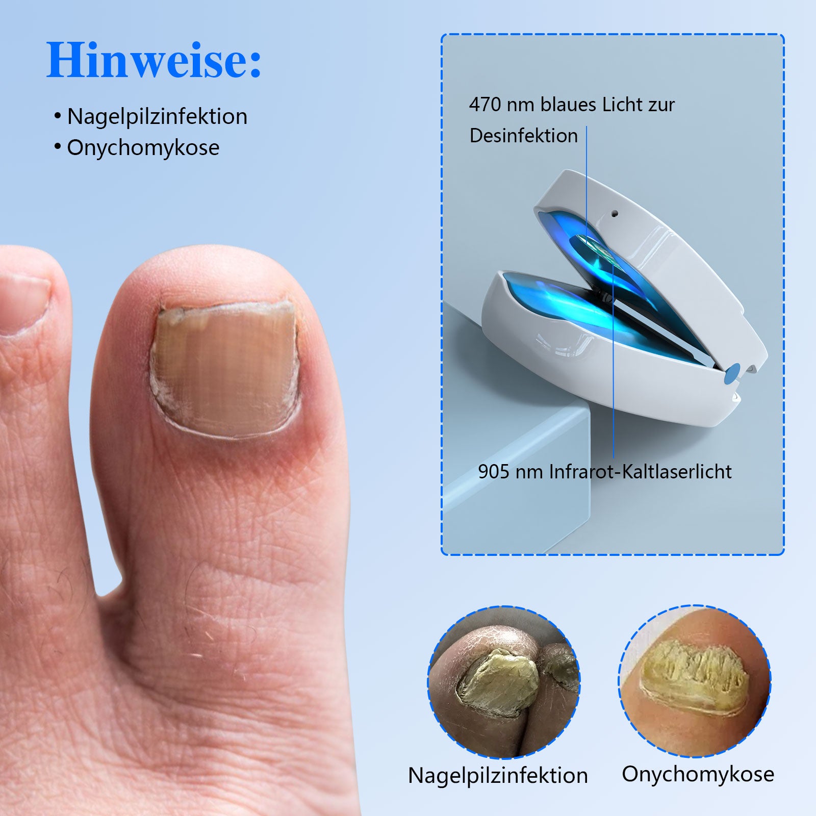 KTS® Nagelpilz Behandlungs Gerät