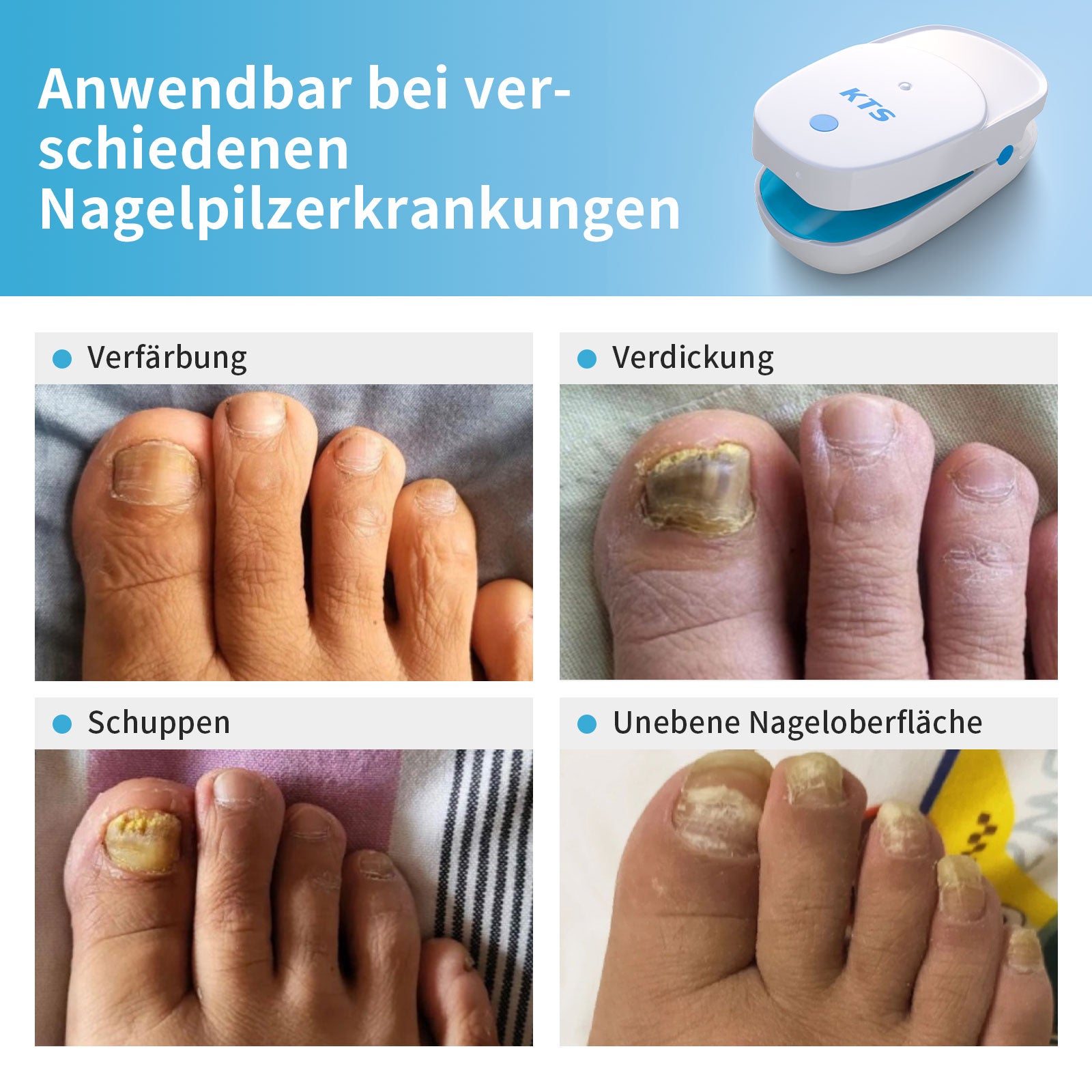 KTS® Nagelpilz Behandlungs Gerät