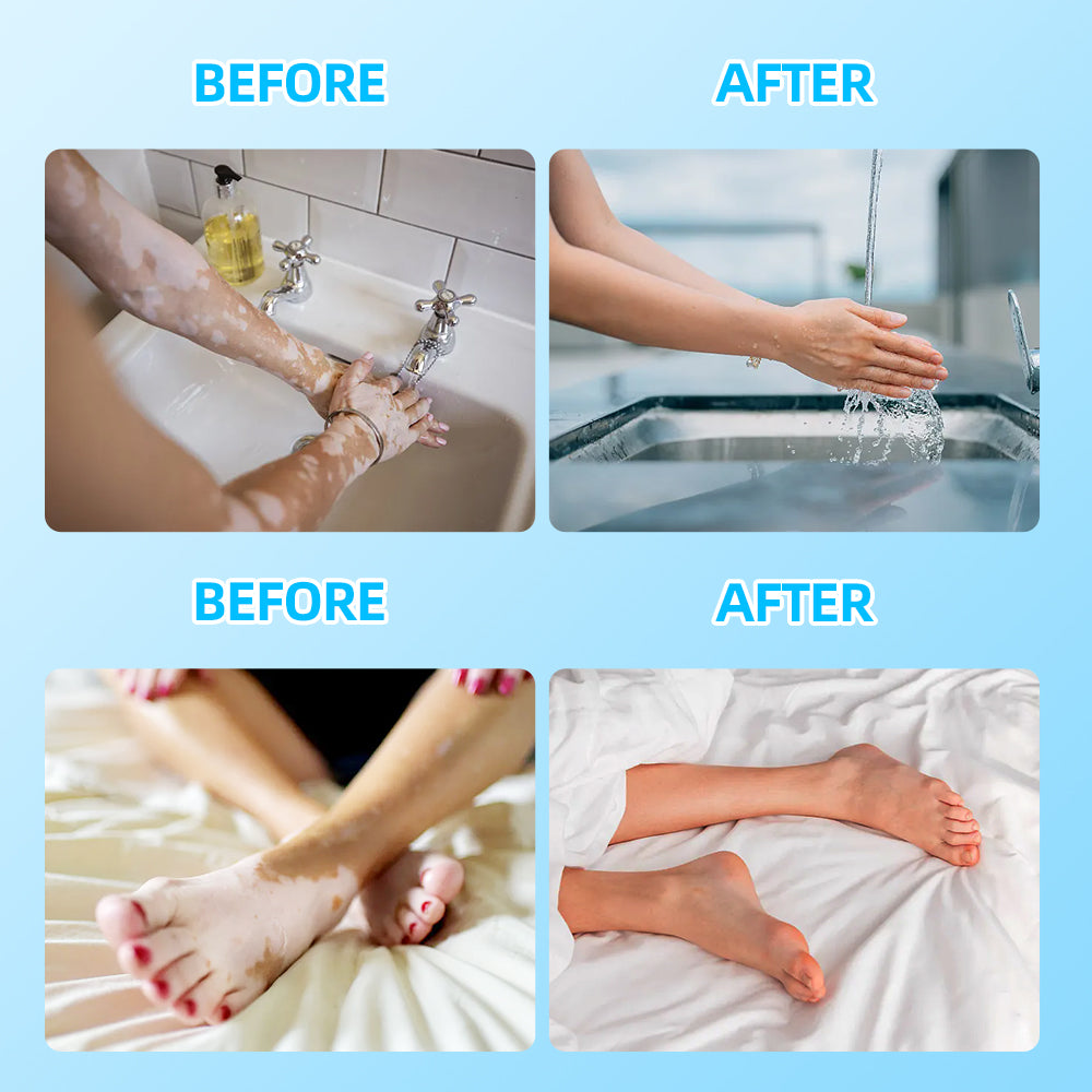 UVB-Vitiligo/Psoriasis-Lichttherapiegerät für zu Hause