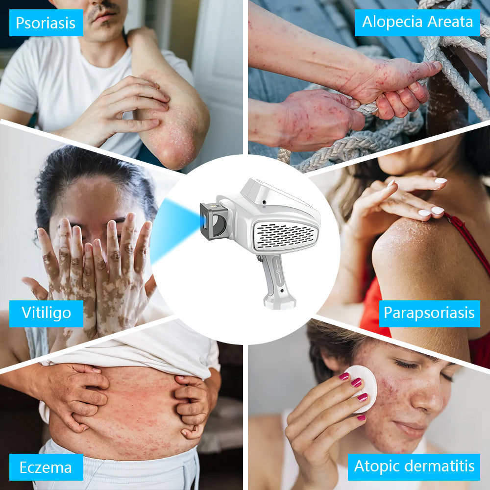 UVB-Vitiligo/Psoriasis-Lichttherapiegerät für zu Hause